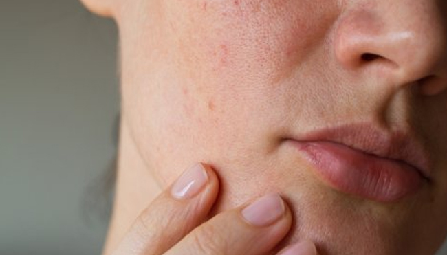 Perhatikanlah Dampak Kandungan Skincare untuk Kulit Sensitif